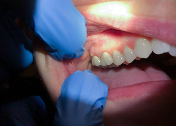 Best Dentist for Tooth Abscess  in Hampton, IA